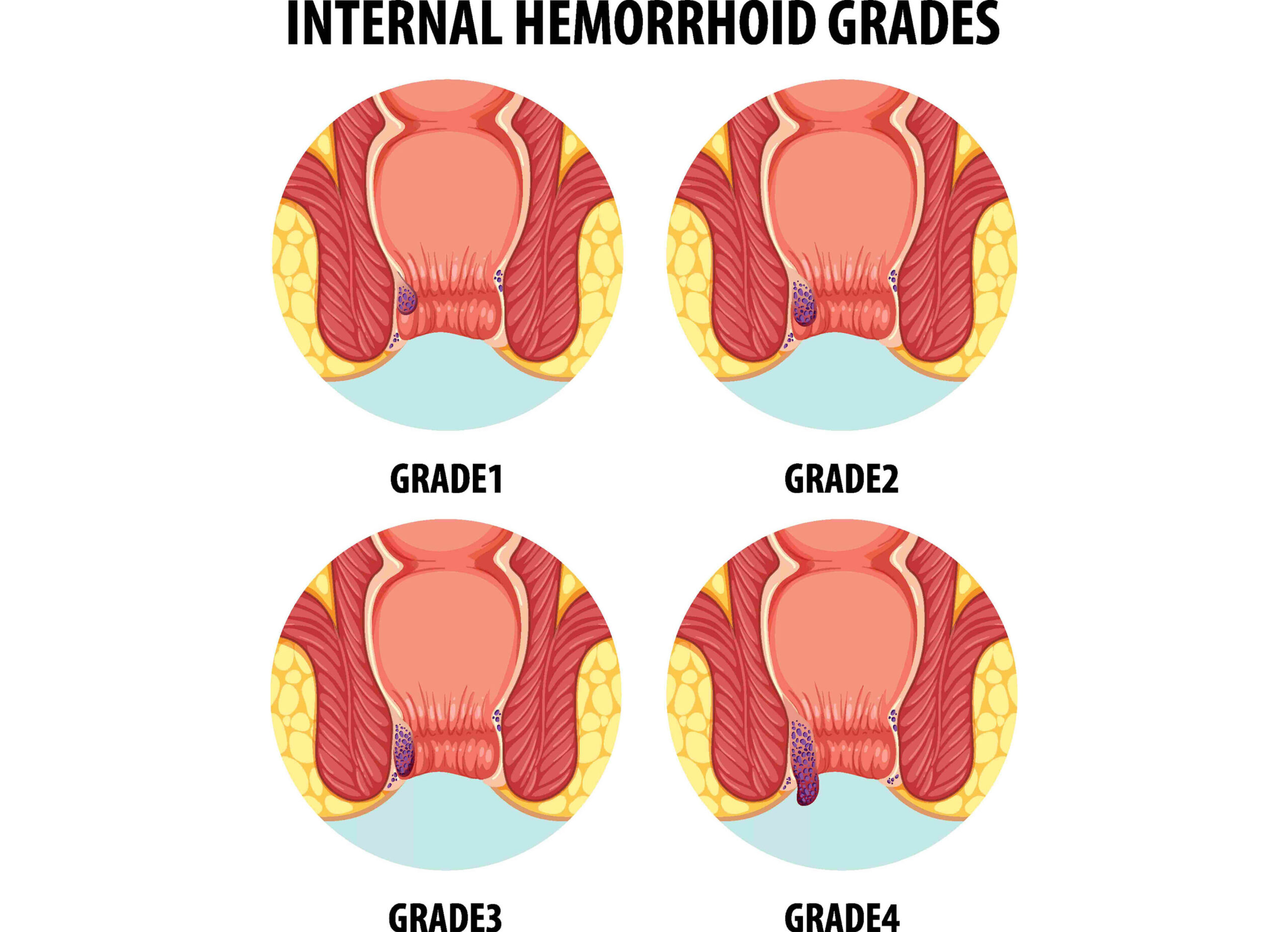 Internal Hemorrhoids
