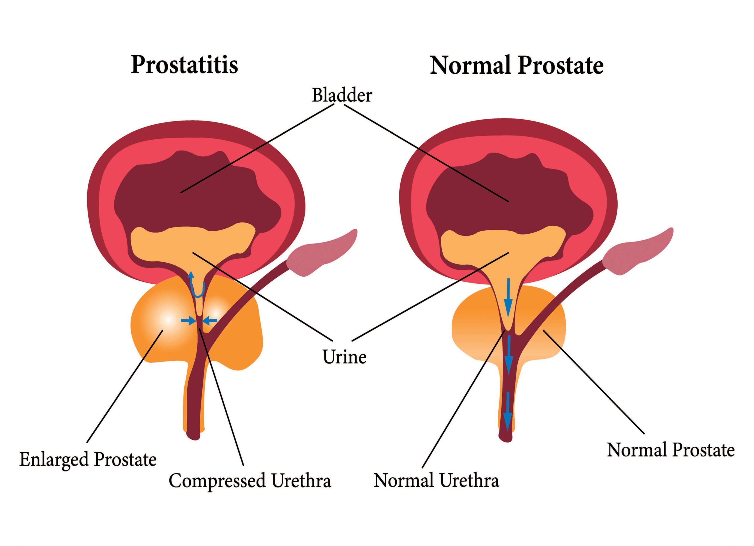 prostatitis