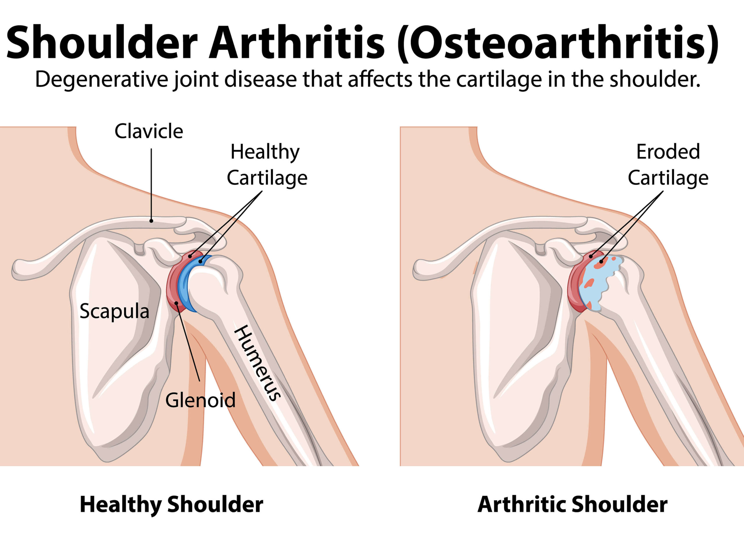 shoulder arthritis